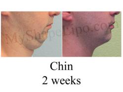 chin liposuction, double chin,